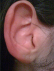 Рисунок 2. Правое ухо пациентки во время эпизода «красного уха» (фотография сделана пациенткой).