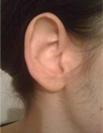 Рис. 1. Нормальный внешний вид правого уха пациентки (фотография сделана пациенткой).